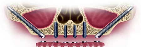 No bone Zygomatic implant at Kochi, Cochin, Kerala