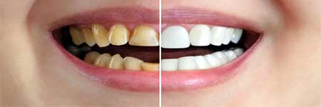 Cosmetic Dentistry at Kochi, Cochin, Kerala